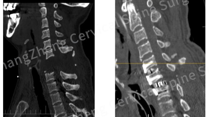 我国医生成功完成“身首离断”式颈椎手术