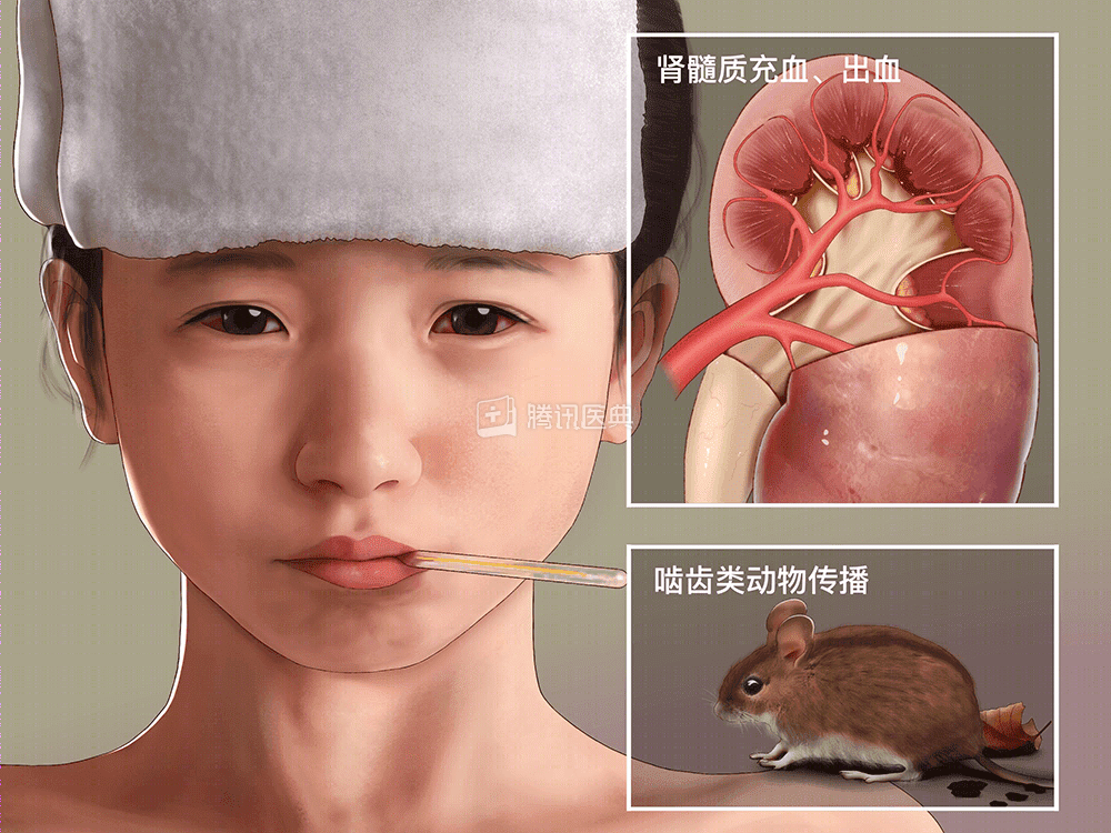 科普|安第斯病毒:可人际传播的汉坦病毒“家族”成员
